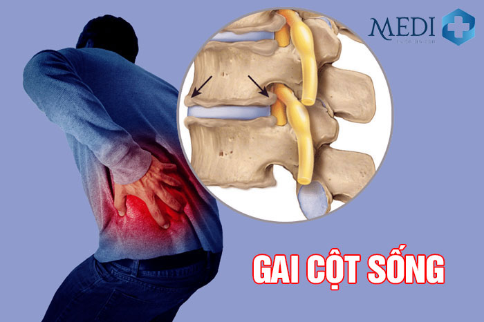 Gai cột sống gây nên những cơn đau kèm tình trạng tê buốt