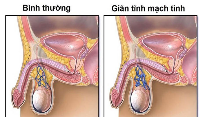 Đoạn thừng tinh bị giãn một bên khiến tinh hoàn bên to bên nhỏ