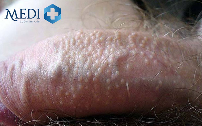 Hạt bã nhờn sinh dục xuất hiện trên da và niêm mạc dương vật