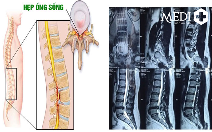 Hẹp ống sống cũng là một nguyên nhân phổ biến gây đau thắt lưng