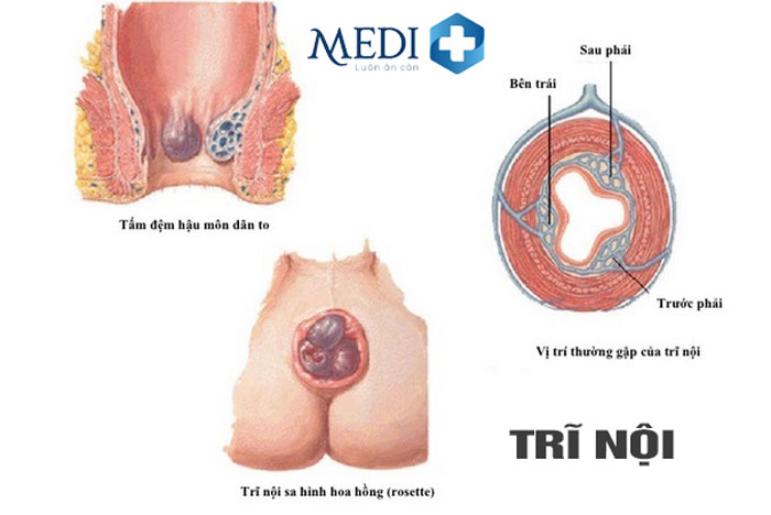 Hình ảnh mô tả búi trĩ ở cấp độ 2 của trĩ nội