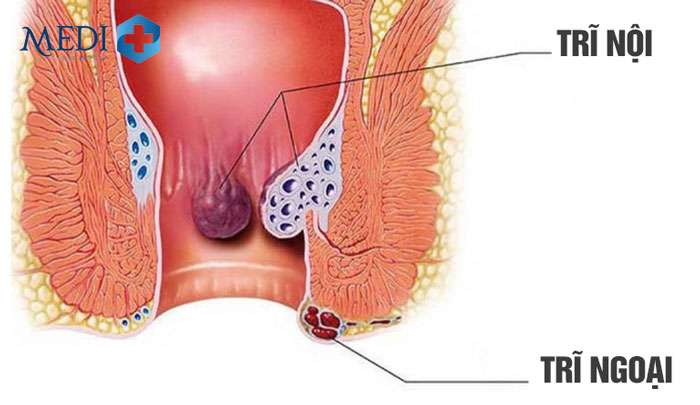 HÌnh ảnh phân biệt trĩ nội và trĩ ngoại