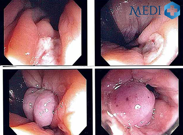 Hình ảnh siêu âm của các búi trĩ nội độ 2