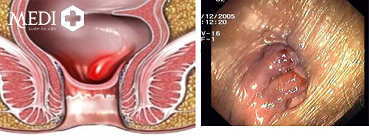 Hình ảnh trĩ nội độ 1 trên thực tế qua nộ soi tiêu hóa