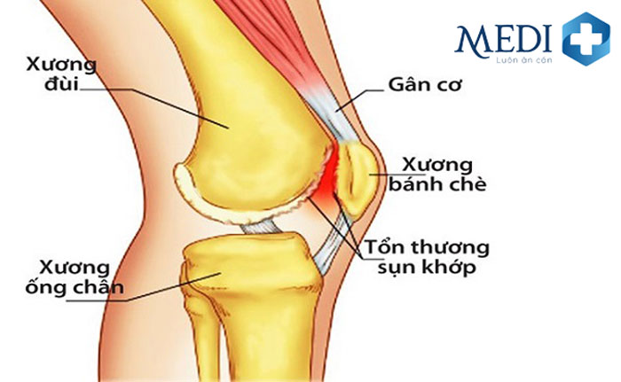 Khớp gối là vị trí dễ bị tổn thương gây khó khăn trong việc di chuyển