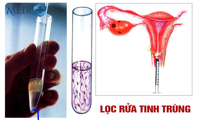 Lọc rửa tinh trùng bơm vào buông tử cung làm IUI