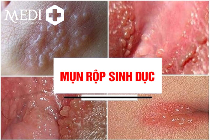 Mụn rộp sinh dục (Herpes sinh dục): Bệnh truyền nhiễm, cách điều trị