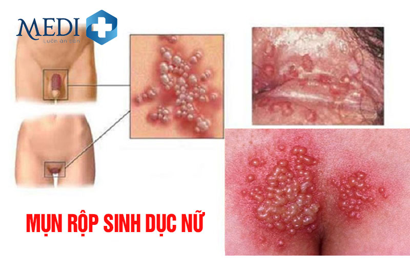 Mụn rộp sinh dục nữ dễ tái phát chớ coi thường