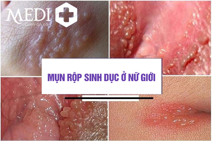 Mụn rộp sinh dục xuất hiện ở cơ quan sinh dục nữ 