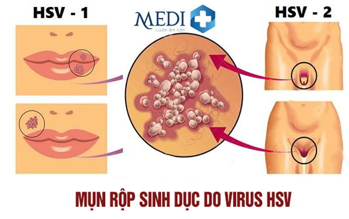 Nguyên nhân gây mụn rộp sinh dục do virus HSV