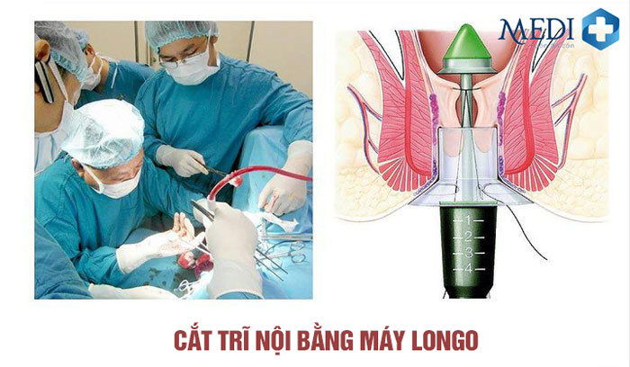 Phương pháp phẫu thuật Longo cắt và loại bỏ búi trĩ