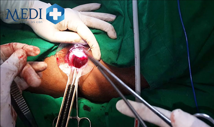 Phẫu thuật cắt loại bỏ búi trĩ ngoại hiệu quả