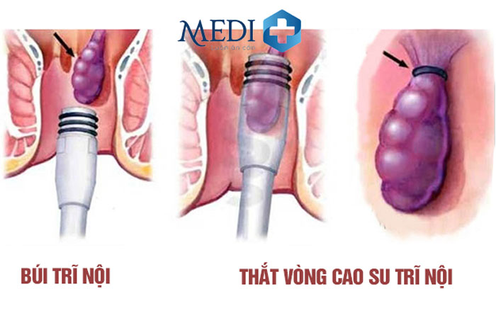 Thắt búi trĩ bằng vòng cao su búi trĩ tao lại và rụng đi