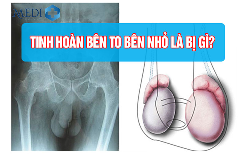 Tinh hoàn bên to bên nhỏ là bệnh gì? Có nguy hiểm không?