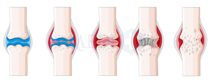 Tổn thương sụn là nguyên nhân khô khớp gối