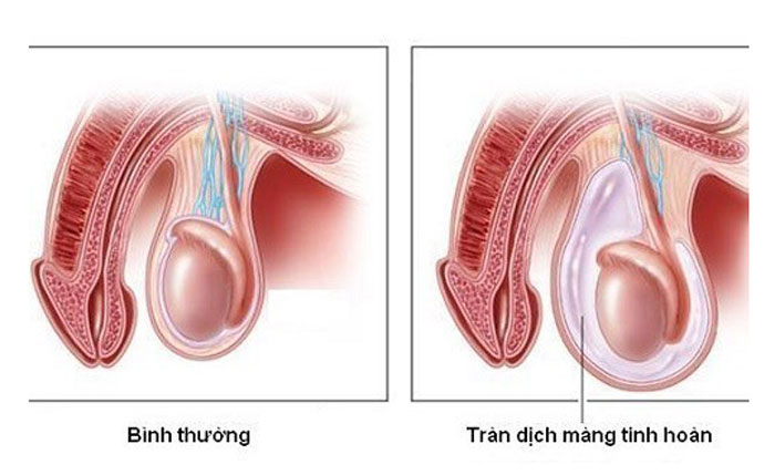 Tràn dịch màng tinh hoàn khiến phần bìu căng lên