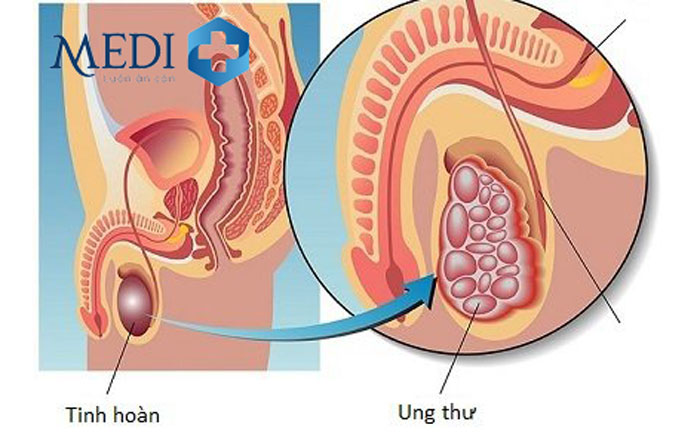 Ung thư tinh hoàn khiến tinh hoàn thay đổi kích thước bất thường