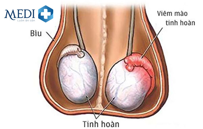 Viêm mào tinh hoàn làm cho tinh hoàn bên to bên nhỏ