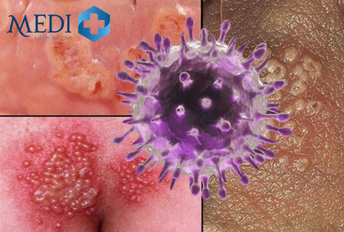 Virus Herpes Simplex (HSV) có hình dạng giống khối đa diện