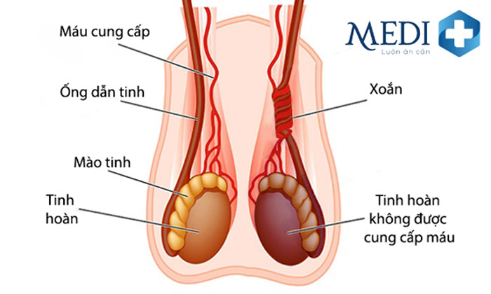 Xoắn tinh hoàn có các cơn đau, bìu sưng to đỏ