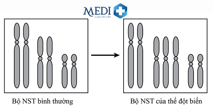 Bất thường trong bộ NST là dấu hiệu của nhiều bệnh lý như: hội chứng down, hội chứng Patau, hội chứng Edwards,..