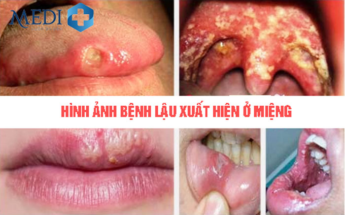 Hình ảnh bệnh lậu xuất hiện ở môi miệng và bên trong hầu họng.