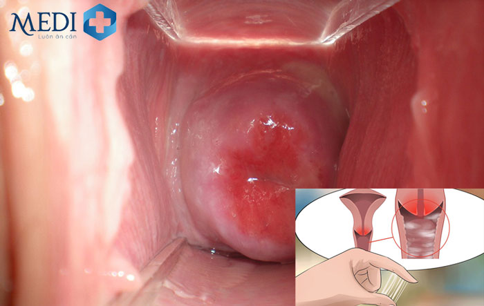 Cổ tử cung bị phù nề và sưng đỏ khi vi khuẩn lậu lan đến