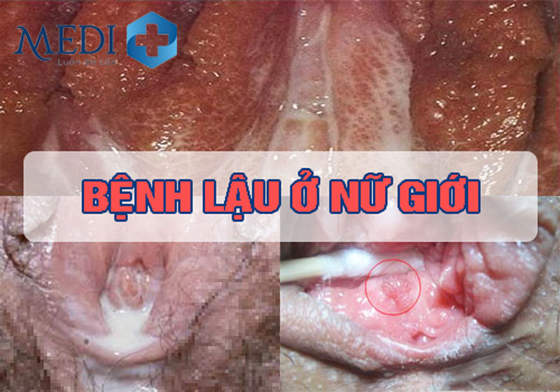 Bệnh lậu ở nữ giới các dấu hiệu nhận biết từng giai đoạn