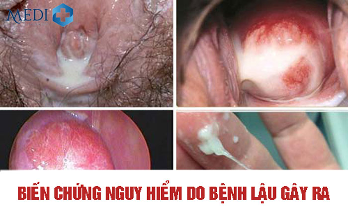 Bệnh lậu mãn tính gây nhiều biến chứng về bệnh phụ khoa ở nữ giới