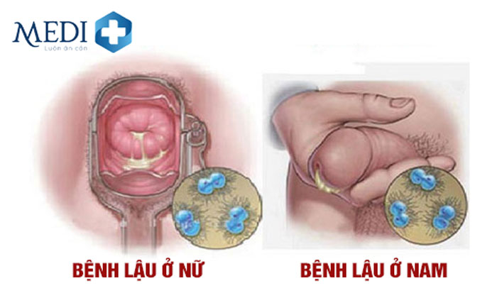 Bệnh lậu xảy ra ở cả nam và nữ giới