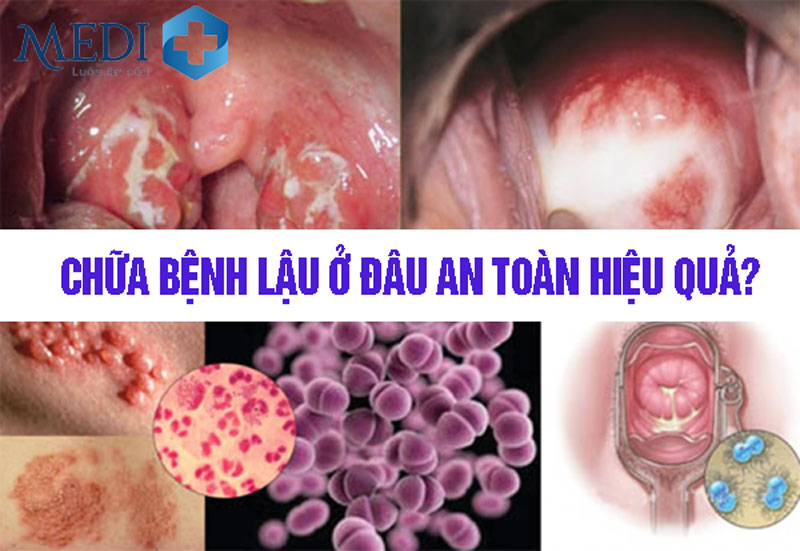 Chữa bệnh lậu ở đâu? TOP 5 địa chỉ chữa bệnh lậu uy tín tại Hà Nội 