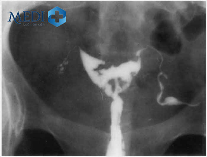 Chụp X quang tử cung vòi trứng giúp phát hiện và dự đoán dính buồng tử cung