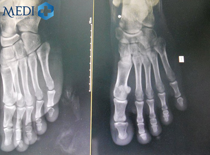 Chụp X quang hỗ trợ chẩn đoán nguyên nhân gây đau mu bàn chân như thoái hóa khớp, xương