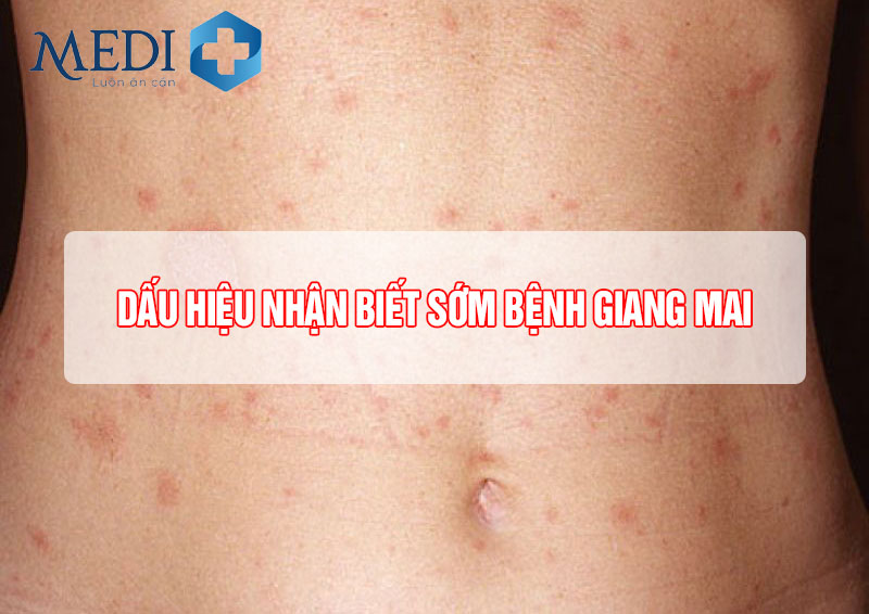 Dấu hiệu bệnh giang mai và cách nhận biết các triệu chứng qua giai đoạn