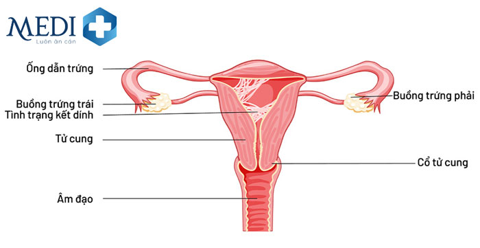 Tử cung là một bộ phận quan trọng của người phụ nữ