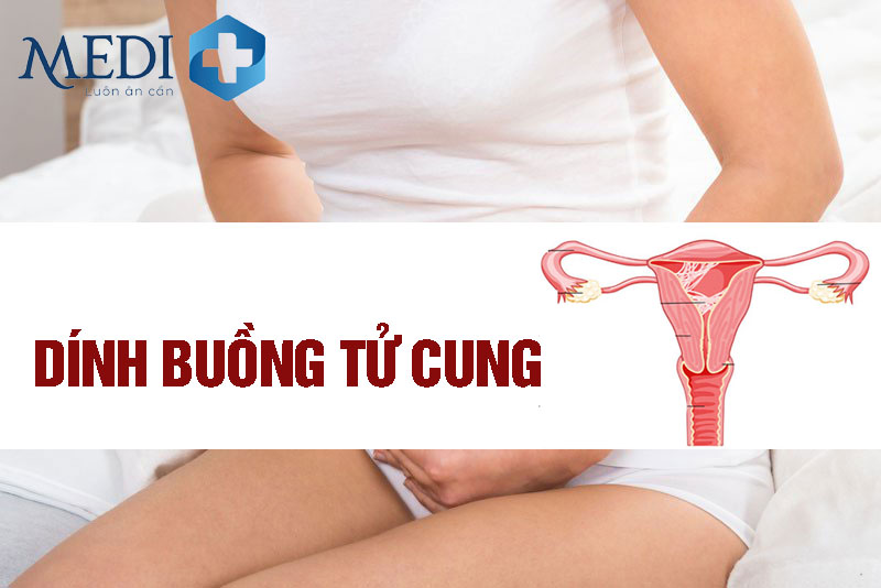 Dính buồng tử cung là gì? Có mang thai được hay không?