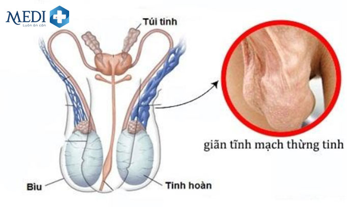 80% trường hợp nam giới vô sinh thứ phát do giãn tĩnh mạch thừng tinh