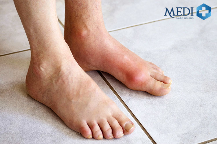 Bệnh gout giai đoạn đầu có triệu chứng mờ nhạt, khó phát hiện