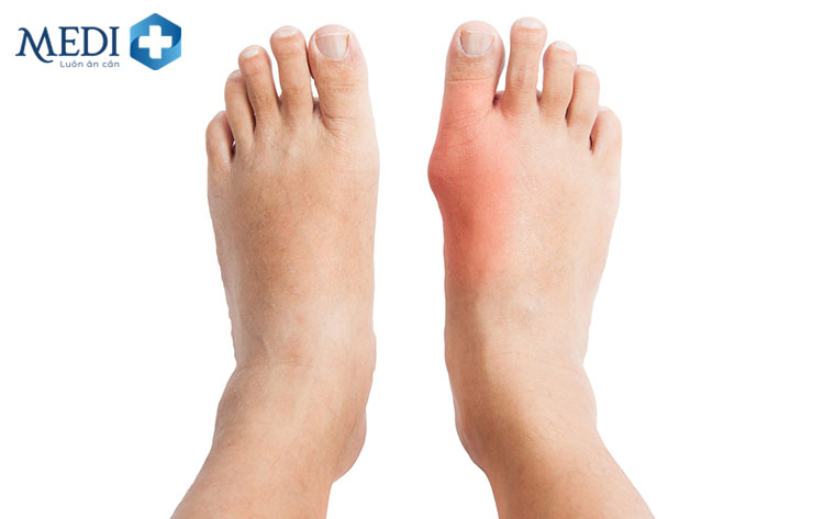 Gout giai đoạn 2 biểu hiện sưng, nóng, đỏ, đau