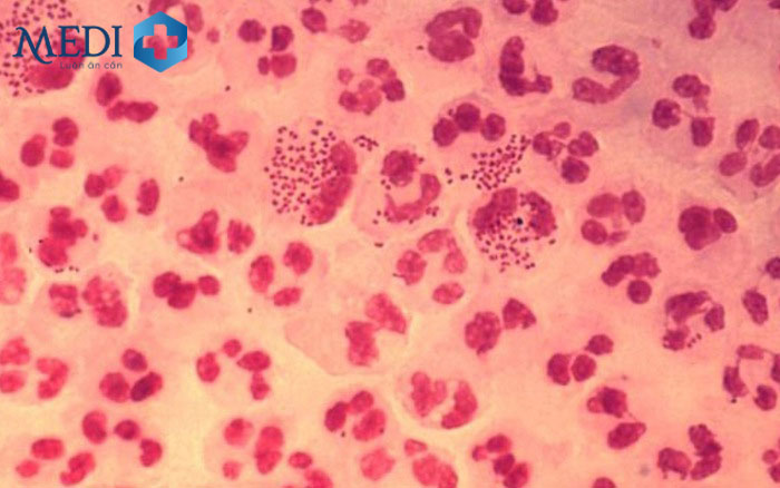 Bệnh lậu do song cầu khuẩn gram (-) Neisseria Gonorrhoeae gây ra