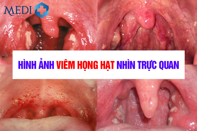 Hình hình họa viêm họng phân tử trực quan lại nhất