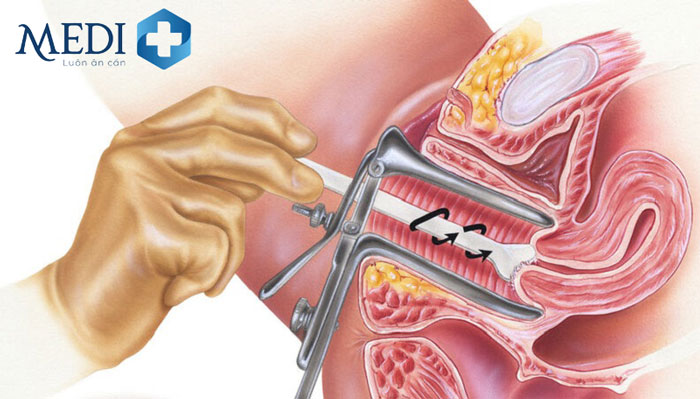 Quy trình lấy dịch âm đạo phụ nữ để làm xét nghiệm