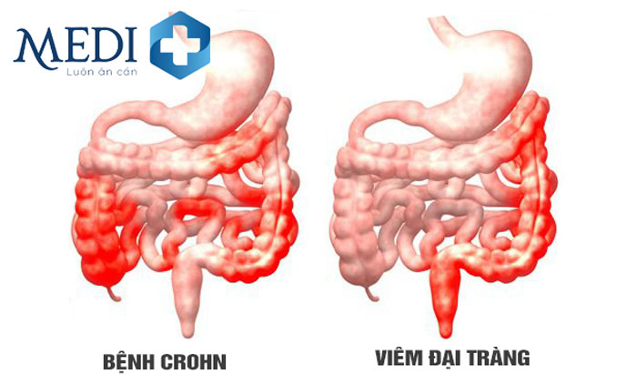 Bệnh Crohn hoặc viêm ruột già là một trong hệ trái khoáy của chỉ số MPV thấp