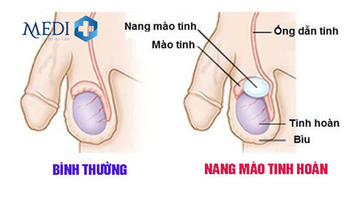 Nang mào tinh hoàn