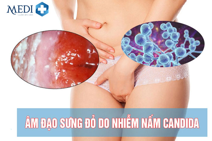 Nhiễm nấm candida, âm đạo sưng đỏ đau nhức chị em phải làm sao?