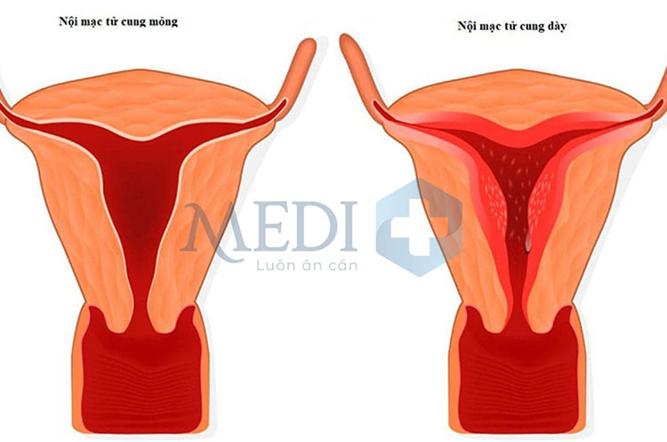 Niêm mạc tử cung mỏng khi độ dày nhỏ hơn 8mm