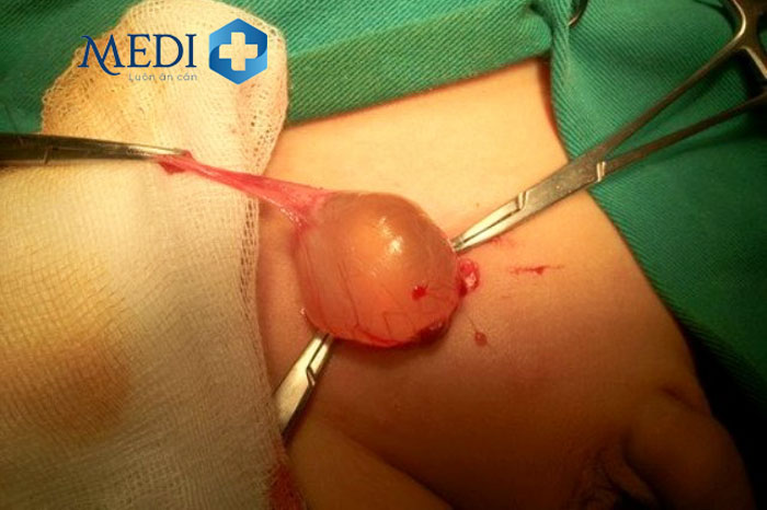 Phẫu thuật bóc tách và loại bỏ các khối nang mào tinh hoàn