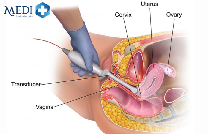 Xác định chính xác tình trạng tắc vòi trứng ở phụ nữ bằng siêu âm đầu dò