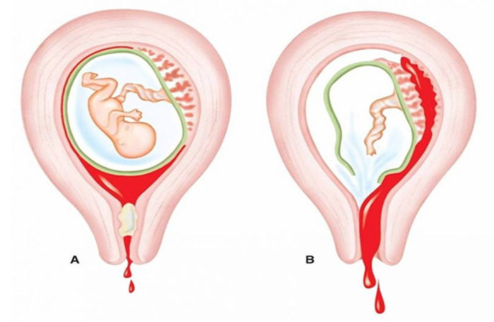 Bị sót nhau thai cung là nguyên nhân hàng đầu gây dính buổng từ cung