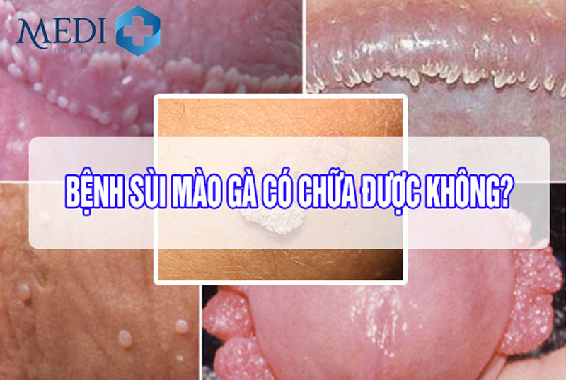 Bệnh sùi mào gà có chữa được không? Chi phí điều trị sùi mào gà